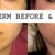 Juvederm Community Photo