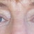 Eyelid Surgery Community Photo