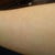 Laser Hair Removal Community Photo