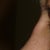 Asian Rhinoplasty Community Photo