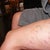 Sclerotherapy Community Photo
