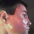 Laser Resurfacing Community Photo