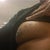 Male Breast Reduction Community Photo
