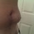 Laser Liposuction Community Photo