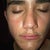 Septoplasty Community Photo