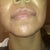 Laser Resurfacing Community Photo