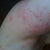 Accutane Community Photo
