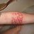 Tattoo Removal Community Photo