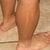 Laser Hair Removal Community Photo