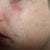 Fractional Laser Community Photo