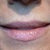 Juvederm Community Photo