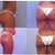 Brazilian Butt Lift Community Photo