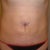 Mini Tummy Tuck Community Photo