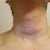 Scar Removal Community Photo