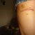 Lipoma Removal Community Photo