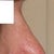 Revision Rhinoplasty Community Photo
