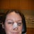 Chin Implant Community Photo