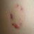 Scar Removal Community Photo