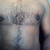 Male Breast Reduction Community Photo
