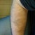 Lipoma Removal Community Photo