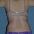 Tumescent Liposuction Community Photo