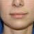 Lip Augmentation Community Photo