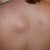 Lipoma Removal Community Photo