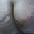 Butt Augmentation Community Photo