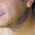 Chin Implant Community Photo