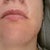 Laser Treatment Community Photo