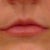 Lip Augmentation Community Photo