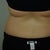Smart Lipo Community Photo