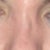 Septoplasty Community Photo
