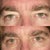 Eyelid Surgery Community Photo
