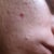 Mole Removal Community Photo