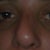 Septoplasty Community Photo