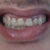 Chin Implant Community Photo