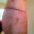 8 days post op, flat butt but that will improve later