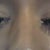 this is now my nose from the front - two months on it is still very swollen on the tip but it is dead straight :)