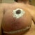 This was about a week after surgery, I had internal dissolving sutures and steri-strips on the outside. The black lines are my stitches.