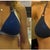 Ok, here's the blue bikini shots side by side for comparison purposes. In the photo on the left I am wearing a 350 sizer on my right breast, and a 375 (they didn't have 380 in the office) on my left.
