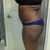 Pre-op side view