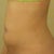 1 month after procedure