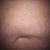 10-31-11 before surgery