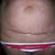 10-31-11 before surgery ~ C-Section Cut