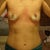 2 days after surgery