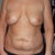 Front View the night before surgery