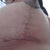 3 Weeks Post Op. Right Breast.