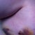 side bruise where drain was. Very black and blue!