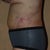 Day 3 Post Op Left
